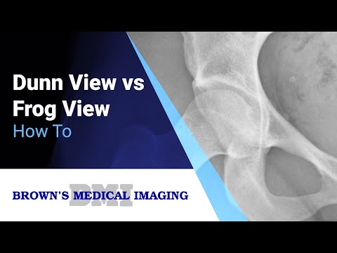 How to Dunn View vs Frog View