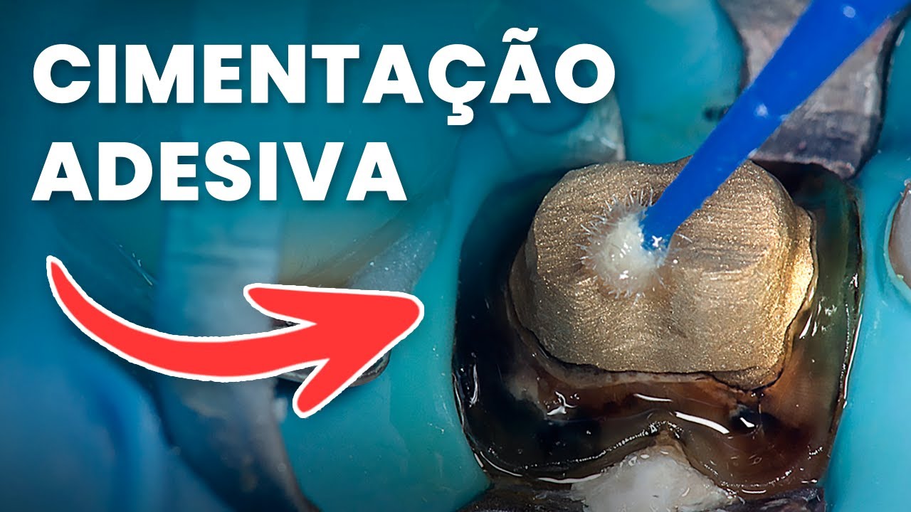 CIMENTAÇÃO ADESIVA - Mylene e Renato