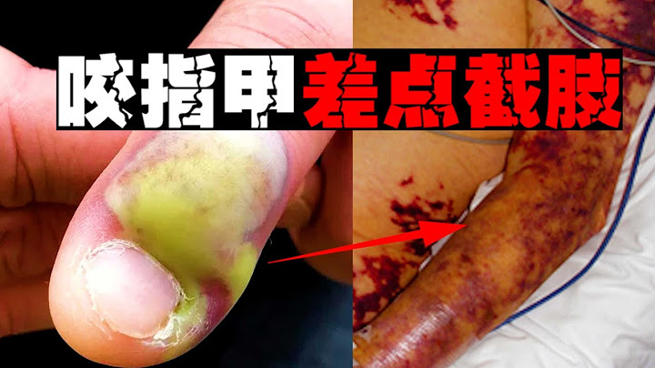 【绝命之咬】咬指甲后血液中毒，手溃烂长斑差点没了#郑郑得证