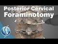 Posterior Cervical Foraminotomy