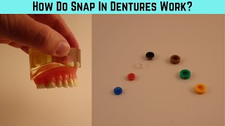 How do snap in dentures work? A close look at implant retained overdenture snaps.