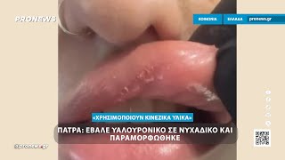 Πάτρα: Έβαλε υαλουρονικό σε νυχάδικο και παραμορφώθηκε – «Χρησιμοποιούν κινέζικα υλικά»