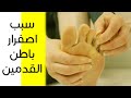 سبب اصفرار باطن القدمين 6 مشكلات صحية قد تسبب تغير لون باطن القدم