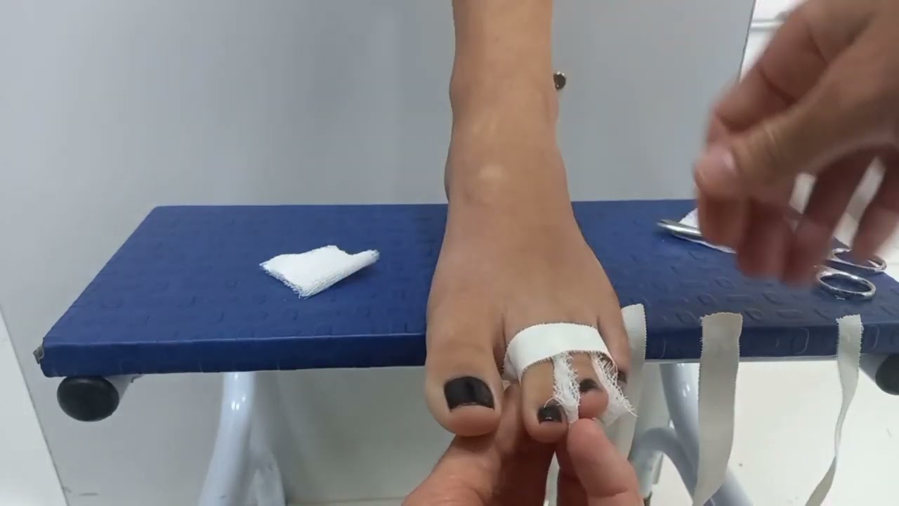 Imobilizações dedo da mão e imobilização dedo do pé