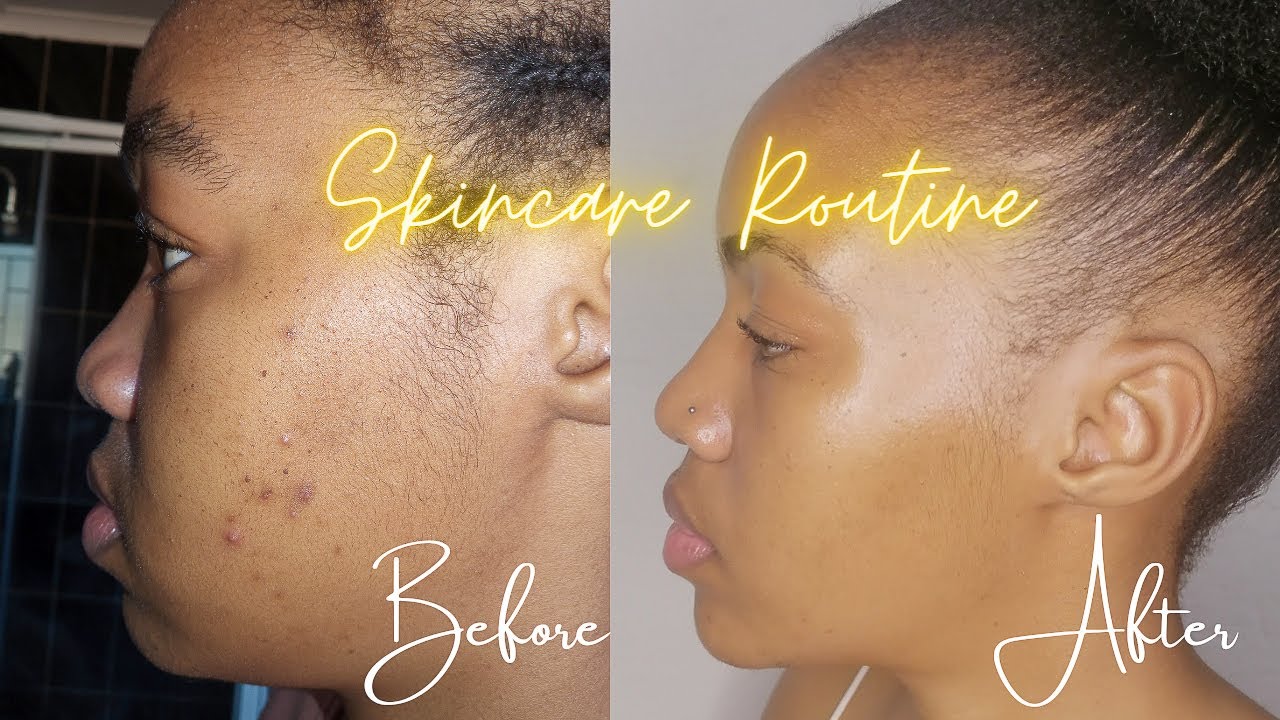 My skincare routine for acne | Under R50! | South African YouTuber