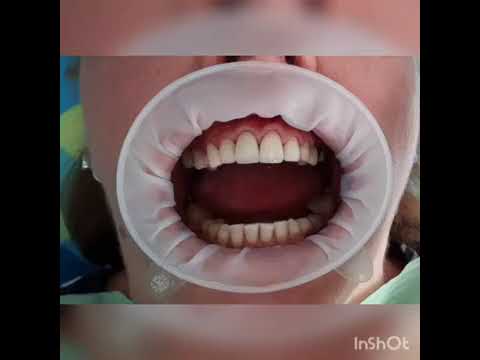 Коронки из диоксид циркония.Примерка коронок.