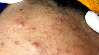 Acne Treatment With Sac Dep Spa #03