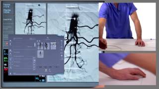 Endovascular Management of a GI Bleed