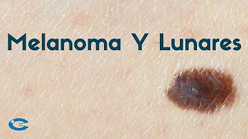 ¿Qué aspecto tiene un lunar pre-melanoma?