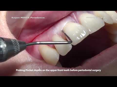 Video: Tandheelkundige En Parodontale Grafieken: Doel En Procedure
