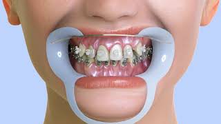 Dental Braces -