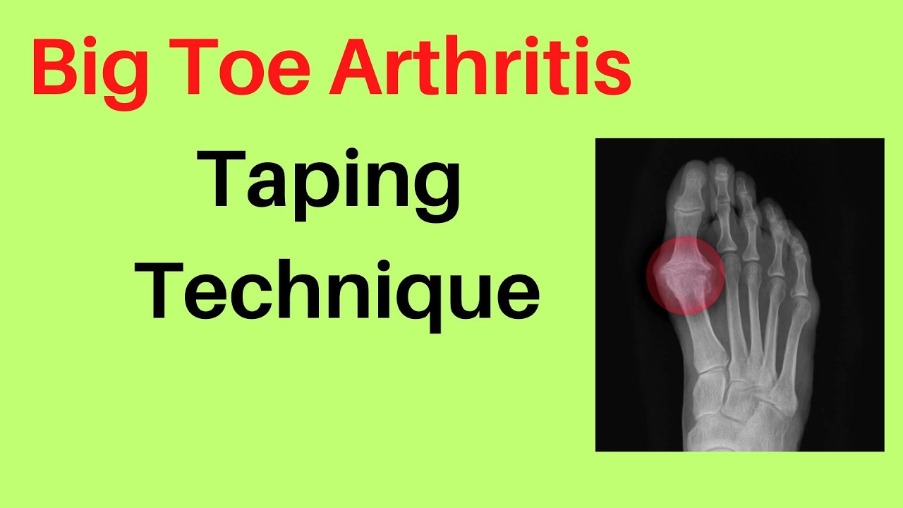 Big Toe Arthritis (Hallux Rigidus): What It Is and How Taping Can Help Manage Pain
