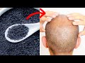यह है वह इकलौती चीज़ जो गंजे सिर पर फिर से उगा सकती है बाल | 100% Effective Hair Regrowth Remedy