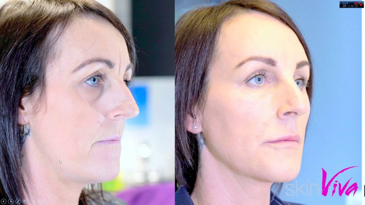 A Vivalift case study with Dr. Tim Non Surgical Facelift SkinViva