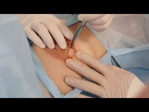 Video: Fibroadenoma - Behandling Av Fibroadenoma Med Folkemedisiner Og Metoder