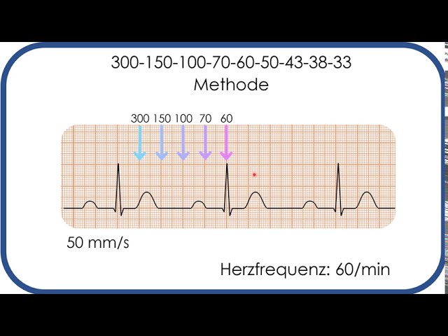 Ekg Befundung Herzfrequenz In Sekunden Bestimmen 300 150 100 Methode Youtube