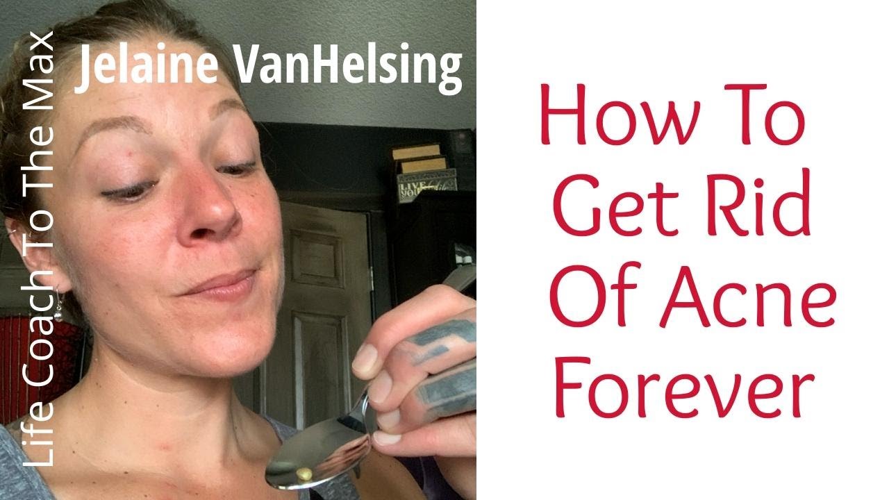 How To Get Rid Of Acne Forever, Jelaine VanHelsing Life Coach To The Max #46
