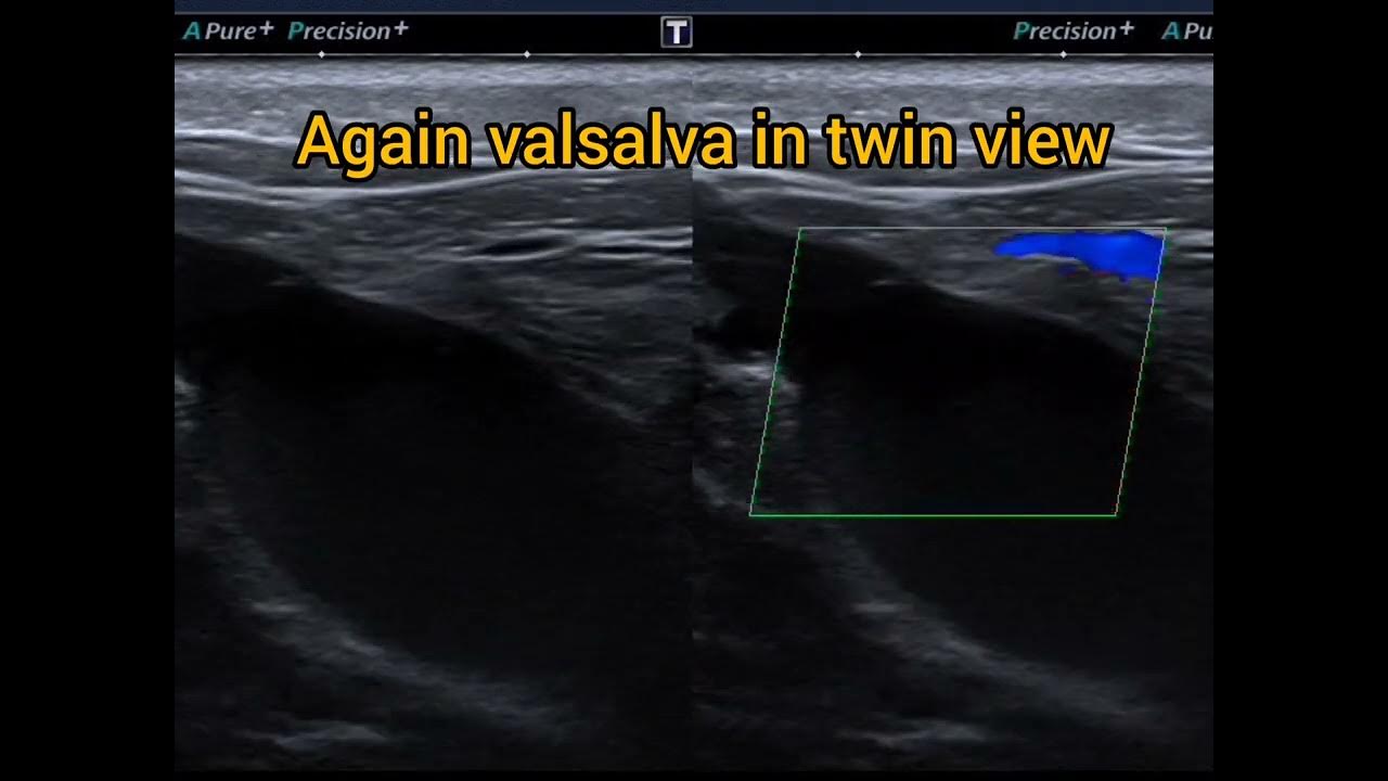 Ultrasound study of a normal and an saphenofemoral junction