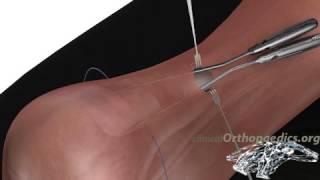 Mini-invasive repair of a ruptured Achilles tendon