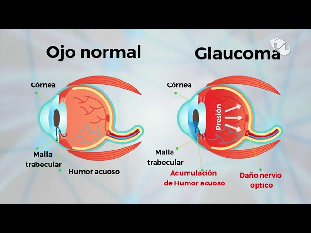 Entrevista al Dr Andrés Díaz por el día mundial del glaucoma