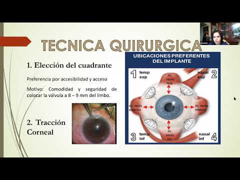 Video: Dispositivo de drenaje para sistemas de drenaje