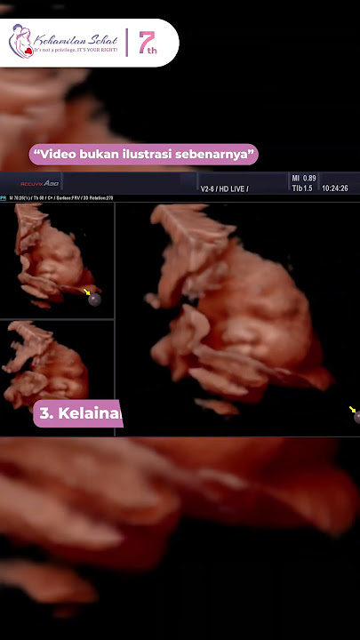 Yuk Lihat Kelainan Apa Saja yang Dapat Terlihat dari USG 4D #shorts