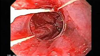Escleroterapia vs ligadura varicosa