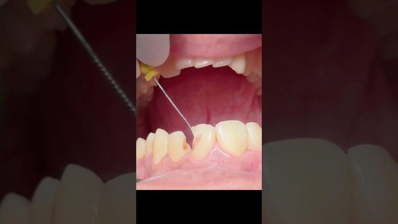 Пульпа — сердце зуба