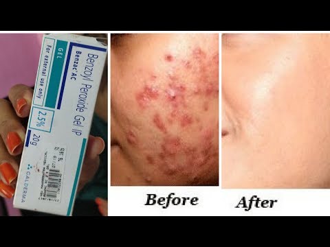 इससे होंगे पिंपल्स खत्म | Clear Acne Pimples once and for all - best solution for acne RabiaSkincare