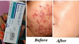 Gel precio ip 20g diclofenaco