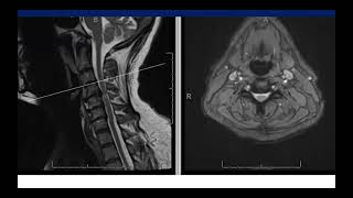 C5 Palsy After C4 C7 ACDF