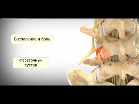 Спондилоартроз/фасеточный синдром: подробнее о факторах  истончения хрящей позвоночника.