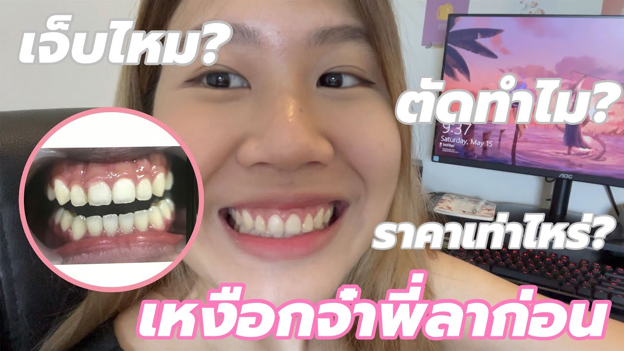 รีวิวตัดเหงือก | Simplypiagy
