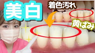 【着色汚れ 歯の黄ばみ】歯を白くする歯磨き粉 〜悩み別①〜