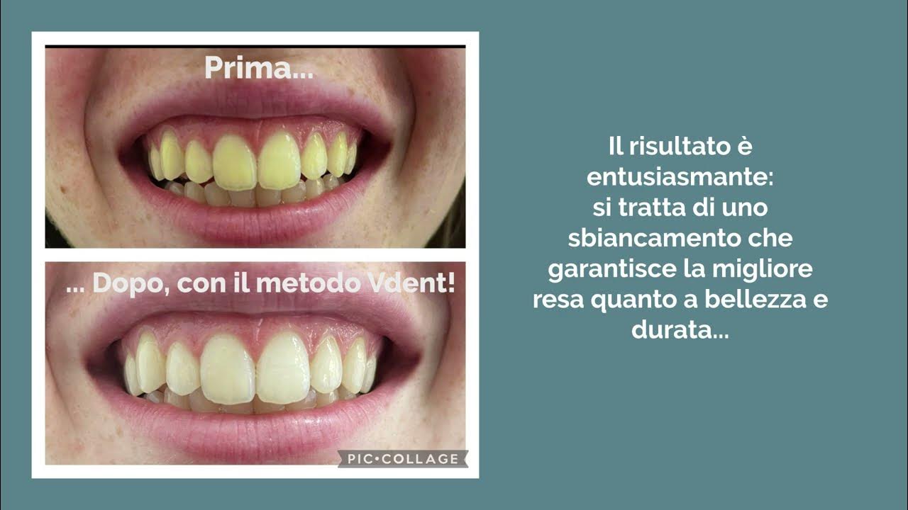 Sbiancamento Dentale prima e dopo! YouTube