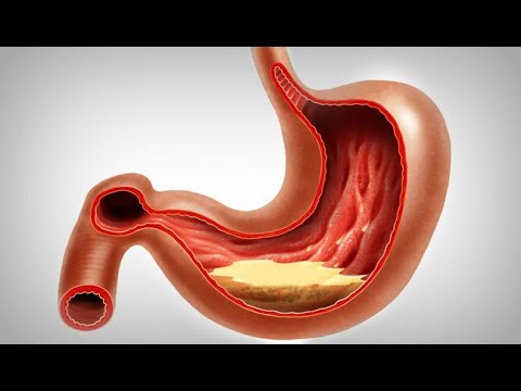 Видео: Тежест в стомаха: симптоми, причини и лечение