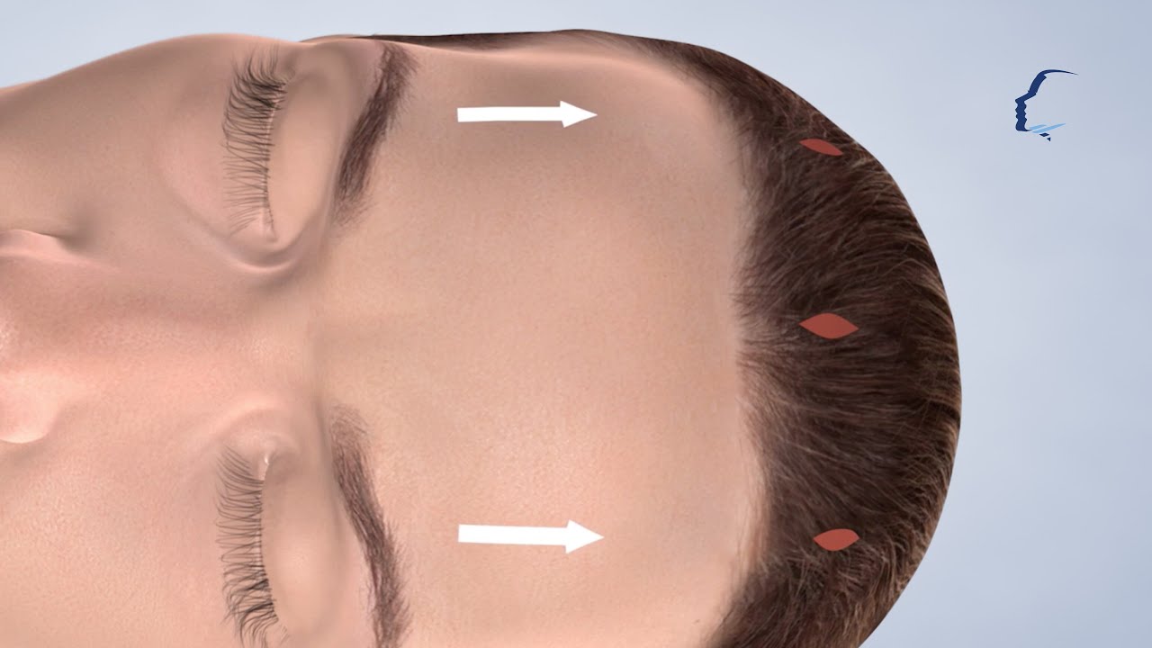 Brow Lift at Carolinas Center for Cosmetic Surgery YouTube