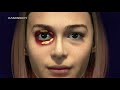 Женская блефаропластика. Women blepharoplasty / KAMINSKYI