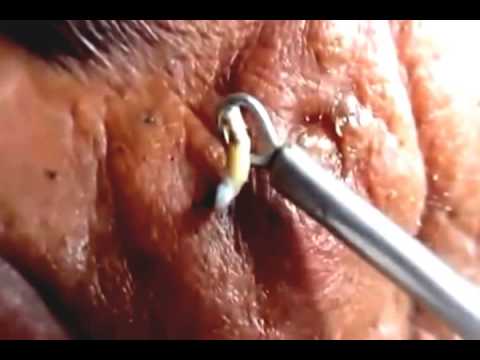 Acne Treatment  BlackHeads On Nose and Very big Cysts on Back Cyst remover YouTube