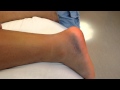 Quick test for Achilles tendon rupture