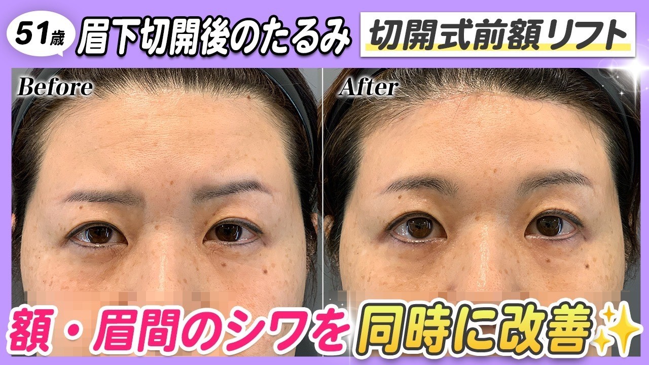 【51歳 額リフト】もっと早くやればよかった✨ドレーンは怖かったけど、払拭するほどの満足感💡【切開式前額リフト】