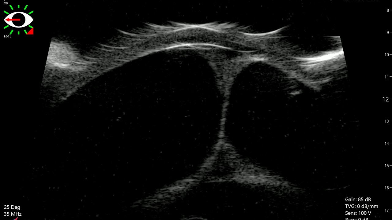 【臨床】UBM for iris bombe a cat by NCHU Ophthalmology Taiwan YouTube