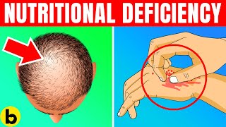 14 Signs That Indicate You Have A Nutritional Deficiency