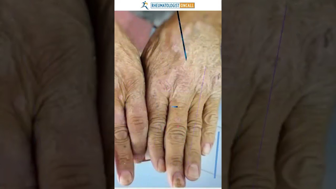 What is systemic sclerosis or scleroderma?