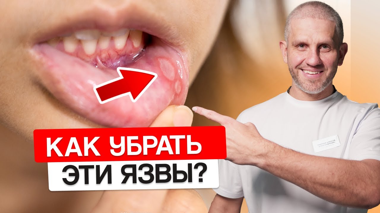 Что делать с ЯЗВАМИ во рту? Легкий СПОСОБ убрать и снять боль