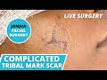 Complicated tribal mark scar revision live surgery  dr tanveer janjua  new jersey