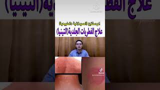 علاج الفطريات الجلدية /دواء لعلاج الفطريات الجلدية