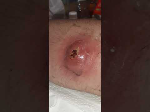 Video: MRSA Pimple: Rozdíly Mezi MRSA A Akné