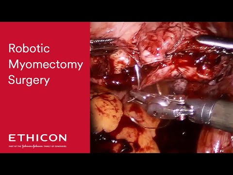 Robotic Myomectomy Surgery to Remove Fibroids | Ethicon