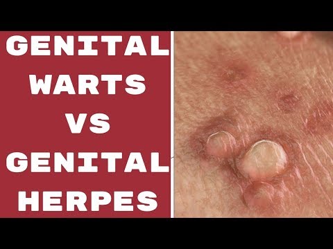 hpv genital warts vs herpes)